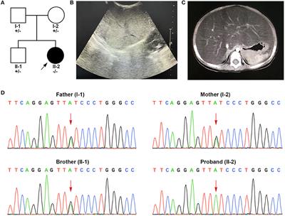 Case Report: Identification of a Novel Homozygous Mutation in GPD1 Gene of a Chinese Child With Transient Infantile Hypertriglyceridemia